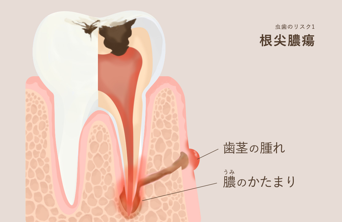 虫歯のリスク1 根尖腫瘍