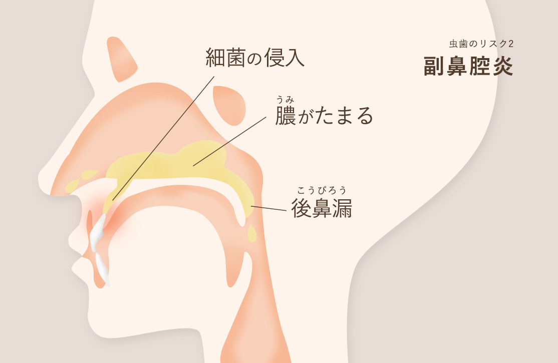 虫歯のリスク2 副鼻腔炎