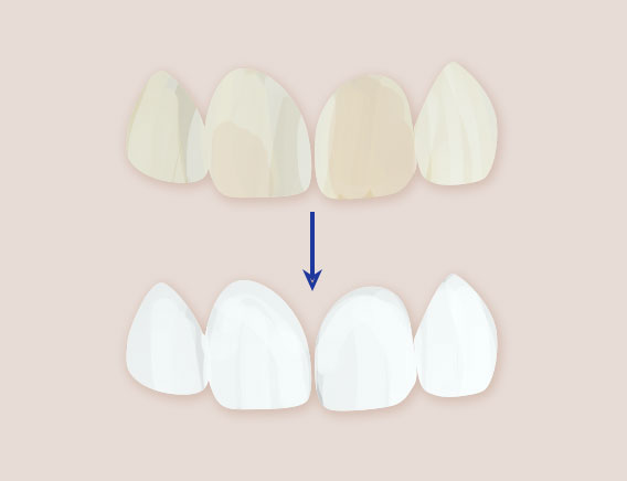 変色した歯をラミネートベニアで審美歯科治療