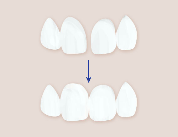 すきっ歯をラミネートベニアで審美歯科治療