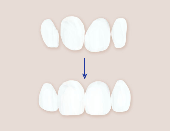 見た目の不揃いをラミネートベニアで審美歯科治療
