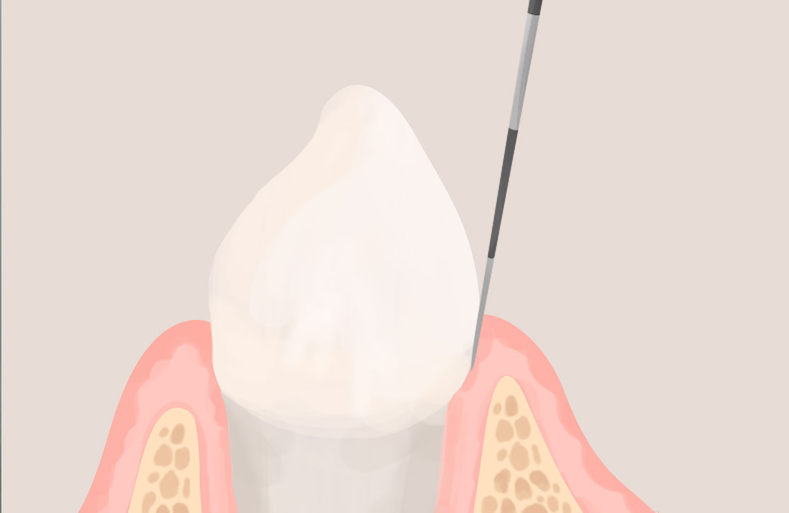 歯周病検査