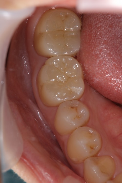 奥歯2歯をセラミックで治療した審美歯科 - 症例紹介 | 宮本歯科