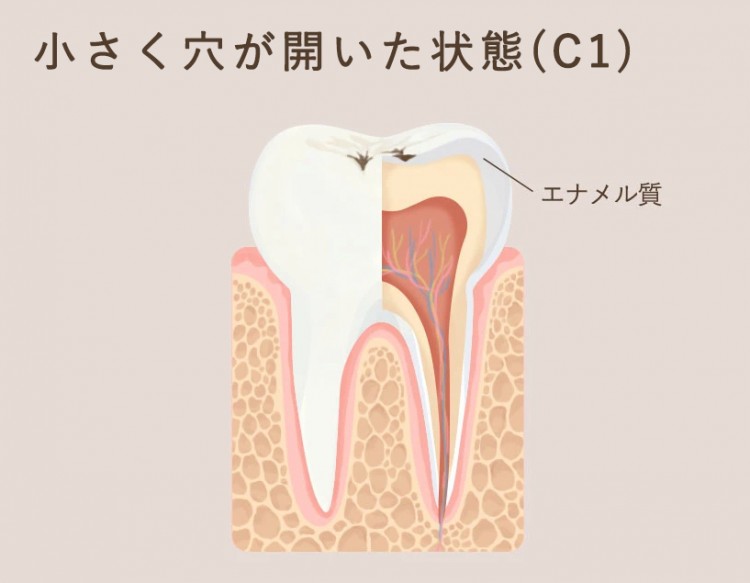 虫歯 歯磨き で 治る